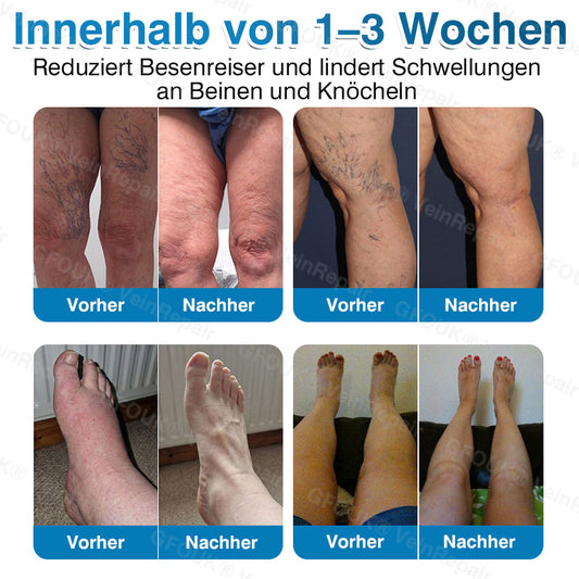GFOUK® VeinRepair Mikronadel-Pflasterrolle⚡
