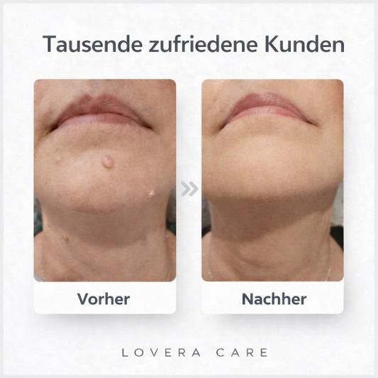 Lovera™ | Pflaster zur Entfernung von Hautanhängseln
