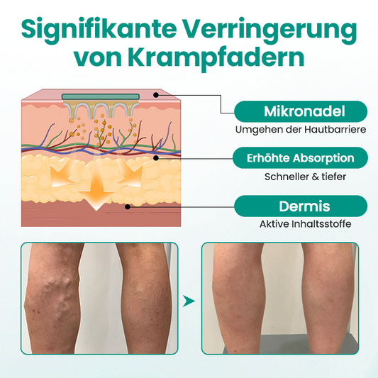 Timilk® LegRenew Krampfaderpflaster