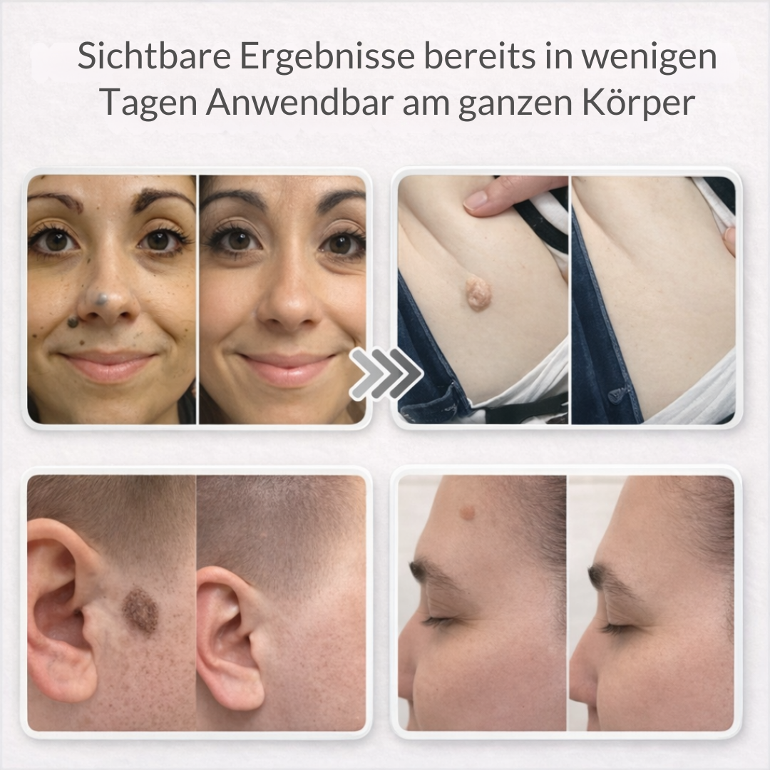 Lovera™ | Pflaster zur Entfernung von Hautanhängseln