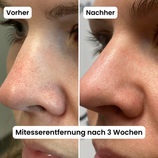 Poren-Reset-Serum (Reis Peeling)