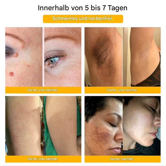 TagFree™ Warzen- & Hautanhängsel Pflege – Für Ein Ebenmäßigeres Hautbild