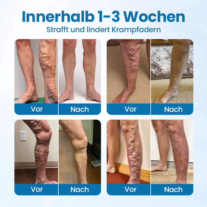 Timilk® VeinGuard Kräuterspray-✅Klinisch erwiesen, um Krampfadern in nur 7 Tagen zu beseitigen!