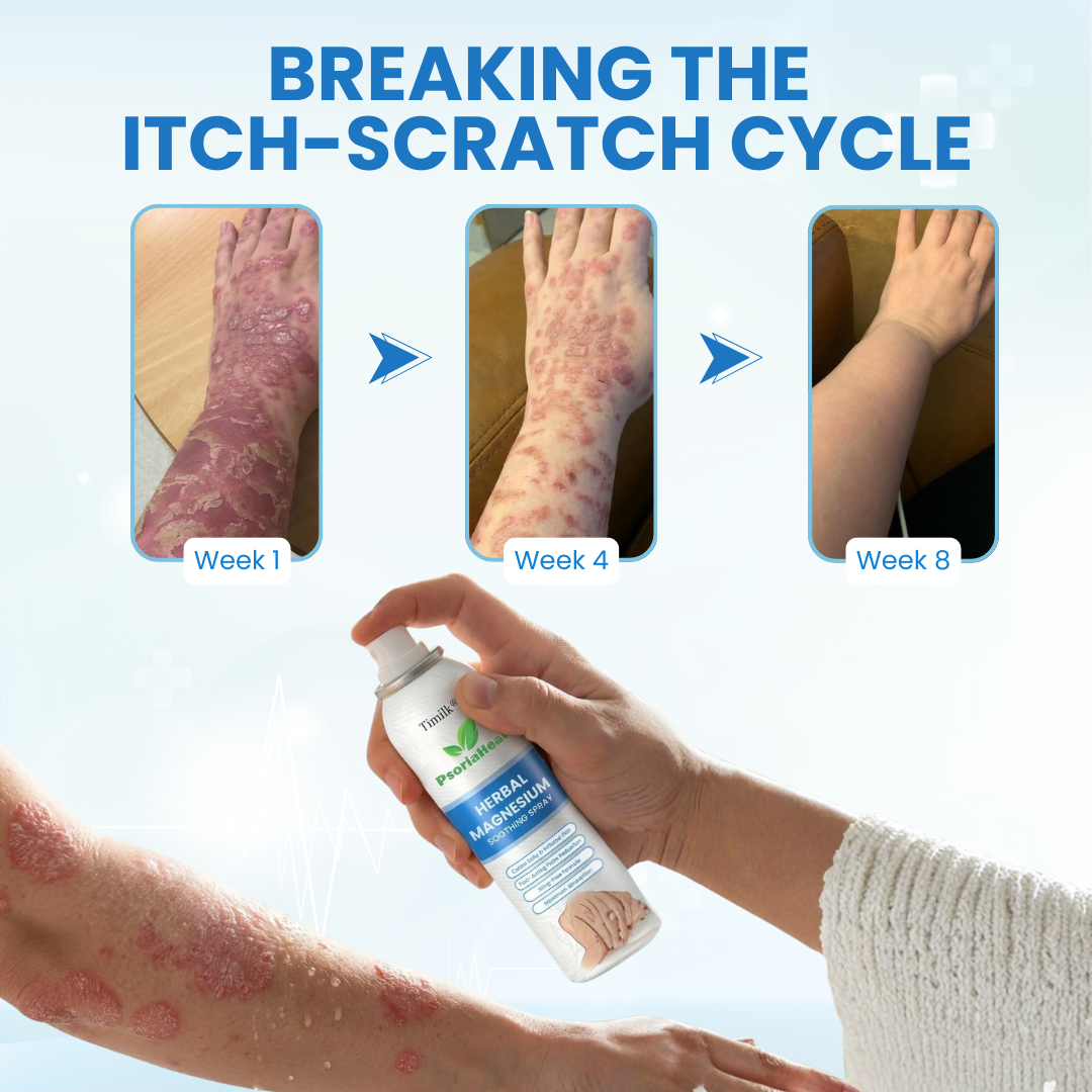 DermaMagna™ PsoriaHeal Magnesium Beruhigungsspray – Schnelle Linderung bei Juckreiz, Rötungen & Hautreizungen