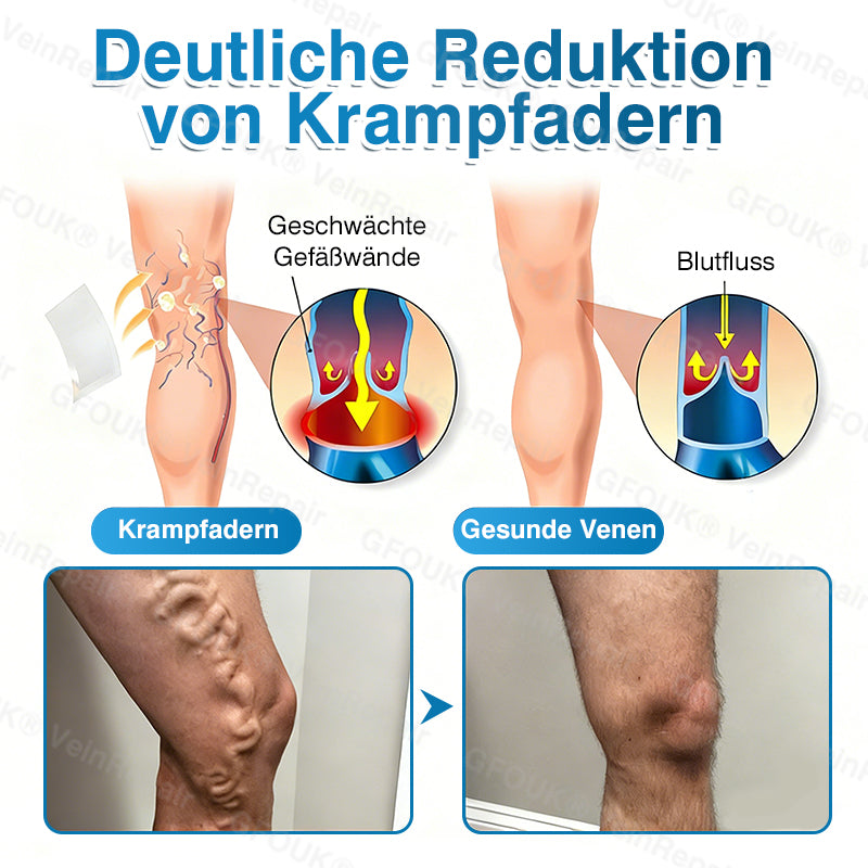 GFOUK® VeinRepair Mikronadel-Pflasterrolle⚡