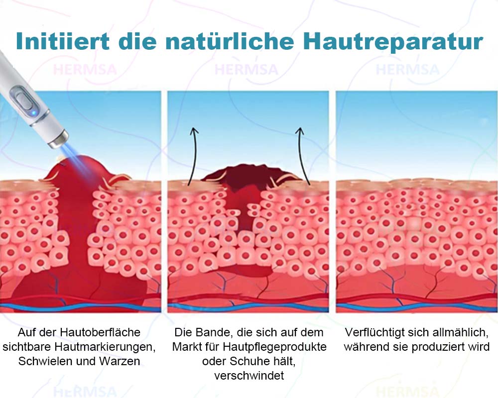 Hermsa® nicht-invasiver Laserpointer - Muttermal- und Warzenentfernung