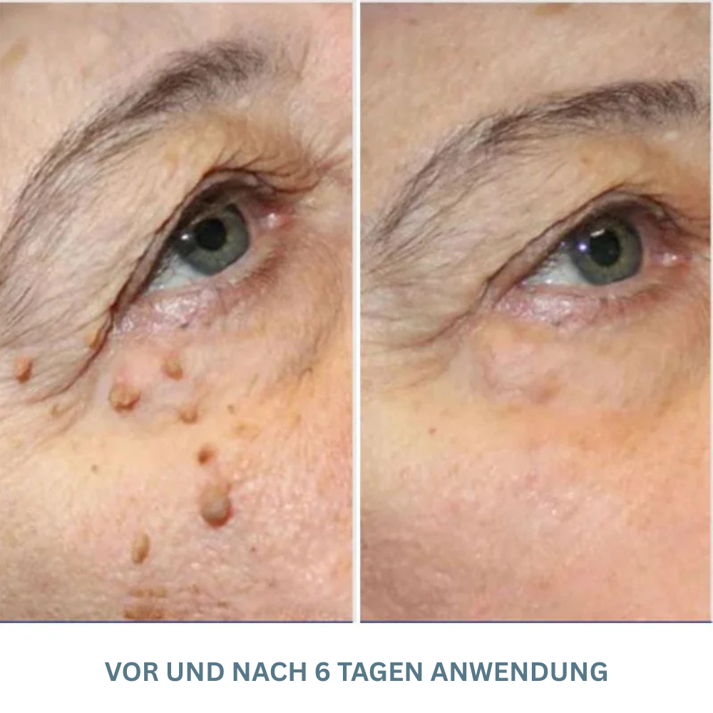 WartsOff™ | Warzen sanft & schmerzfrei entfernen!