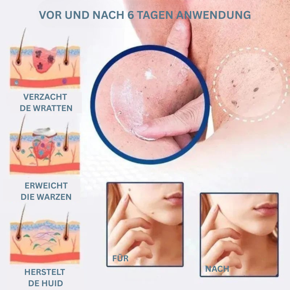 WartsOff™ | Warzen sanft & schmerzfrei entfernen!