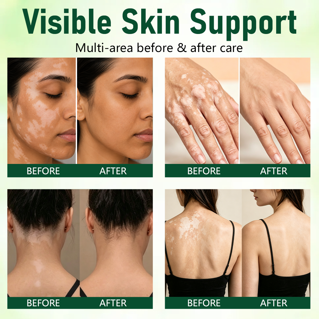 Vitarelle™ Herbal Vitiligo Creme – 7-Tage-Pflege für sichtbar gleichmäßigeren Hautton