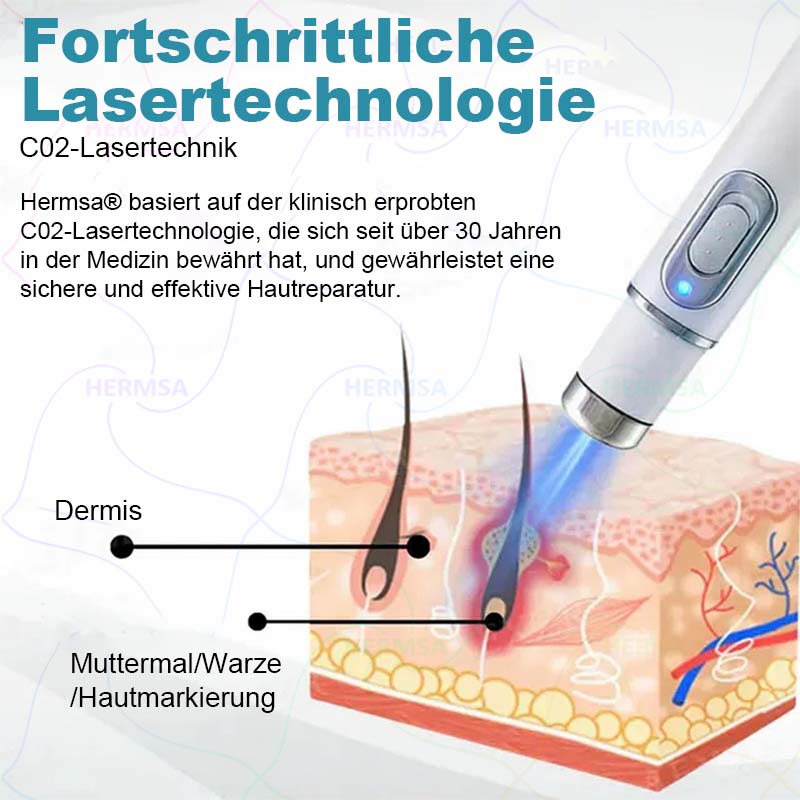 Hermsa® nicht-invasiver Laserpointer - Muttermal- und Warzenentfernung