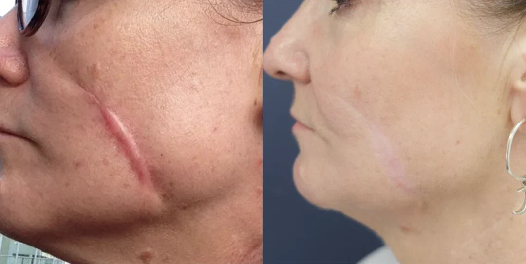 Revella™ Narbenpflege-Gel – Für Ein Ebenmäßigeres & Gepflegteres Hautbild