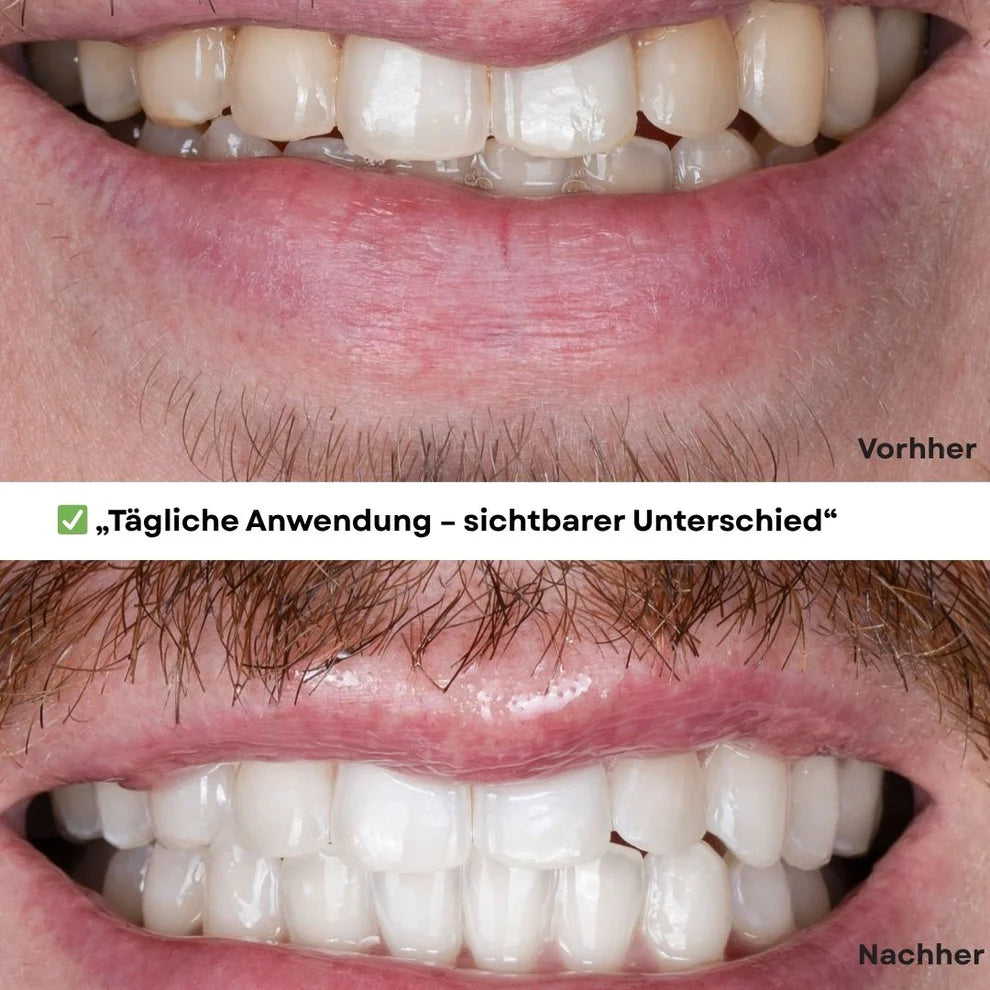 JetSmile™ Professionelles Zahnaufhellungs-Set
