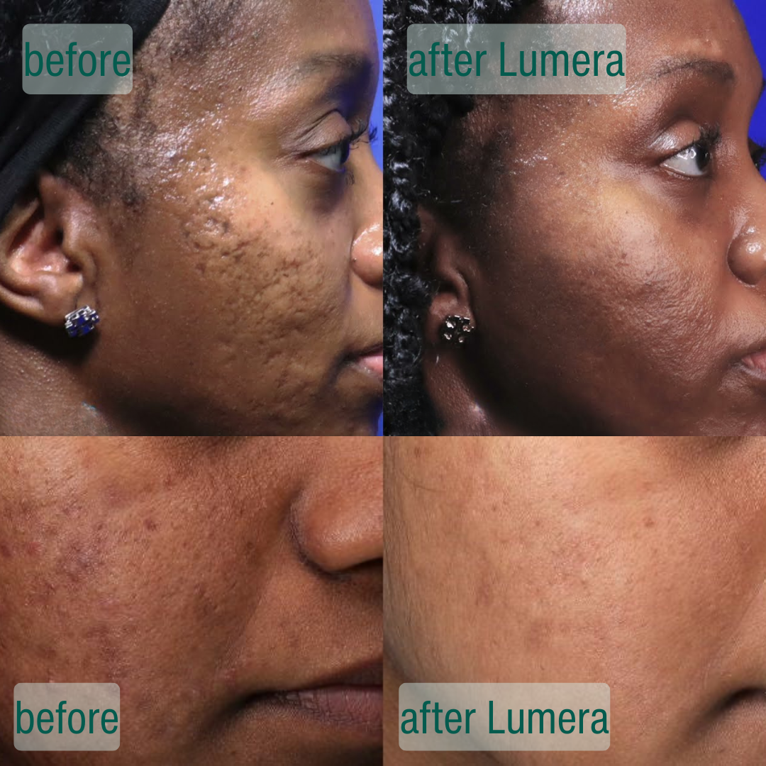Dermora™ MicroCrystal Nachtserum Duo – Für Sichtbar Glattere Haut & Weniger Sichtbare Aknenarben