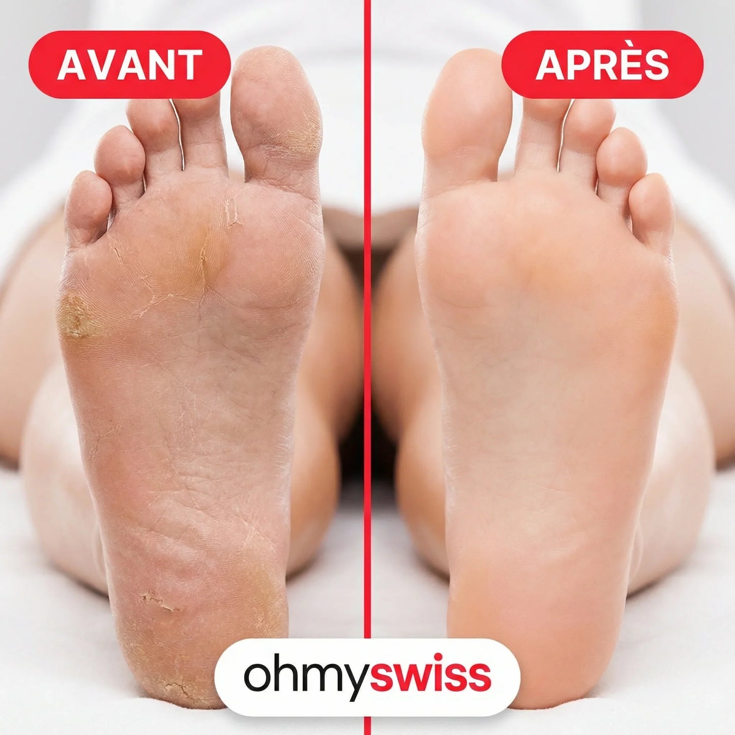 Swiss™ | FootGlow Hornhaut entferner