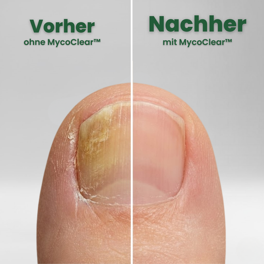 MycoClear™ | Nagelpflege-Patches