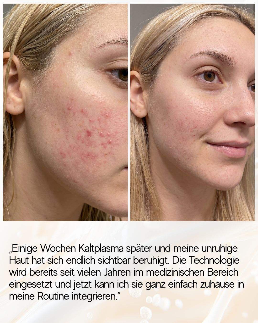 Coldplasma™ - Hautpflege-Booster