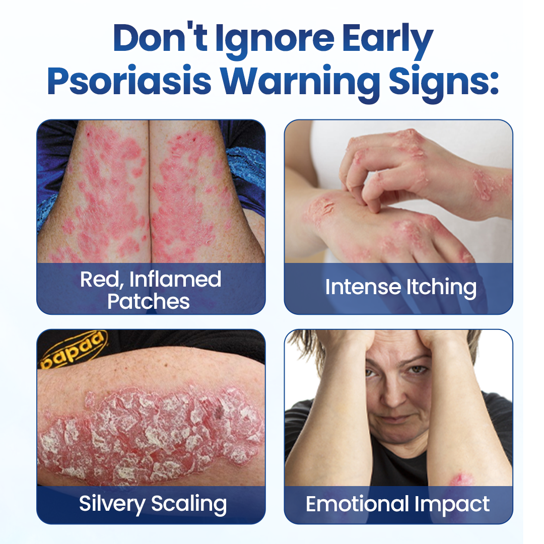 PsoriaVelle™ No-Rub Psoriasis Spray – Gezielte Pflege bei Juckreiz & Schuppen