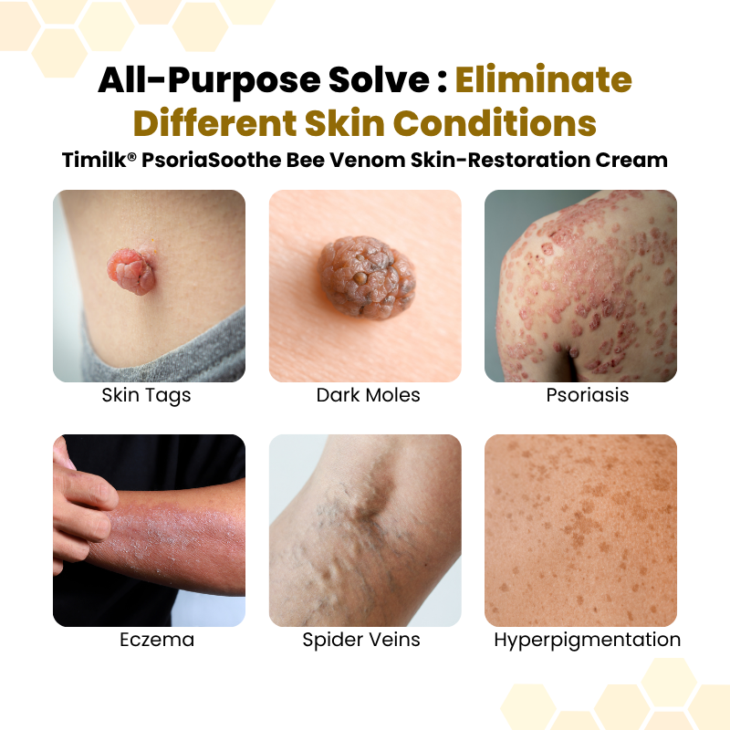 CalmiDerm™ Psoriasis-Hautpflegecreme – Juckreiz in 60 Sekunden lindern & schuppige Haut beruhigen