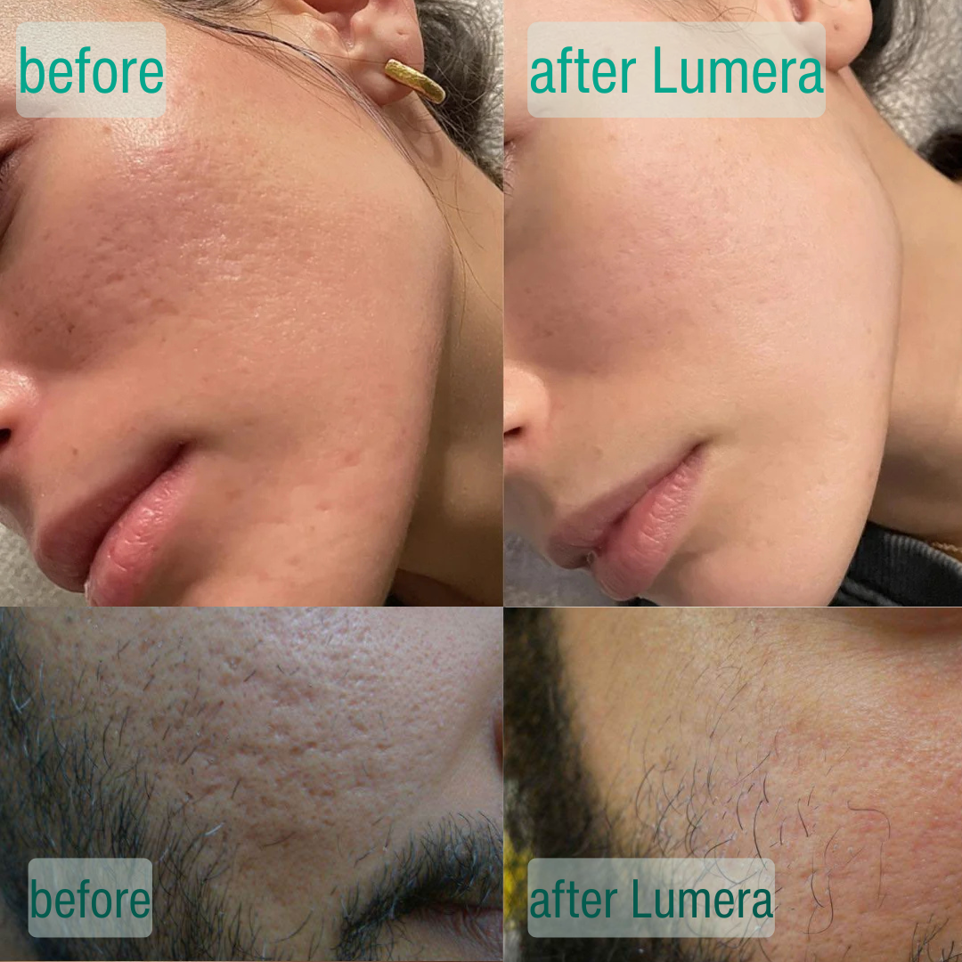 Dermora™ MicroCrystal Nachtserum Duo – Für Sichtbar Glattere Haut & Weniger Sichtbare Aknenarben