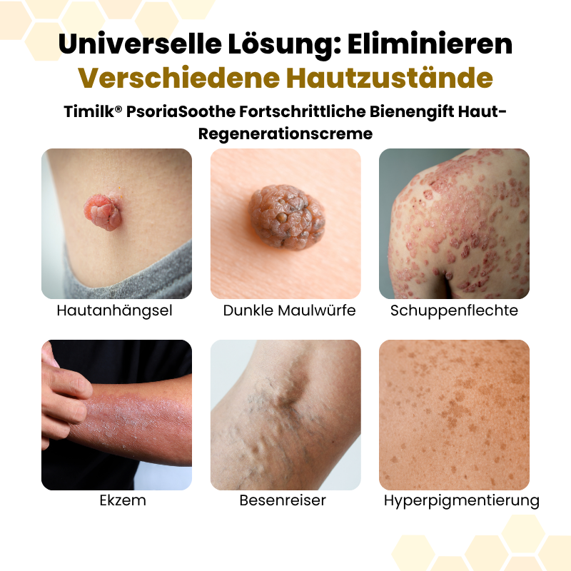 Timilk® | PsoriaSoothe Fortschrittliche Bienengift Haut-Regenerationscreme