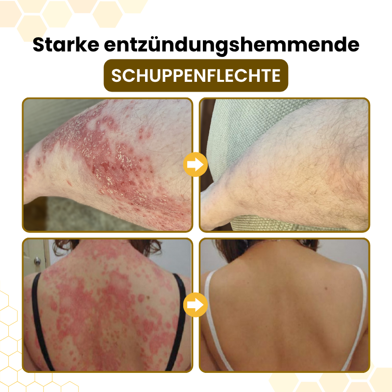 Timilk® | PsoriaSoothe Fortschrittliche Bienengift Haut-Regenerationscreme