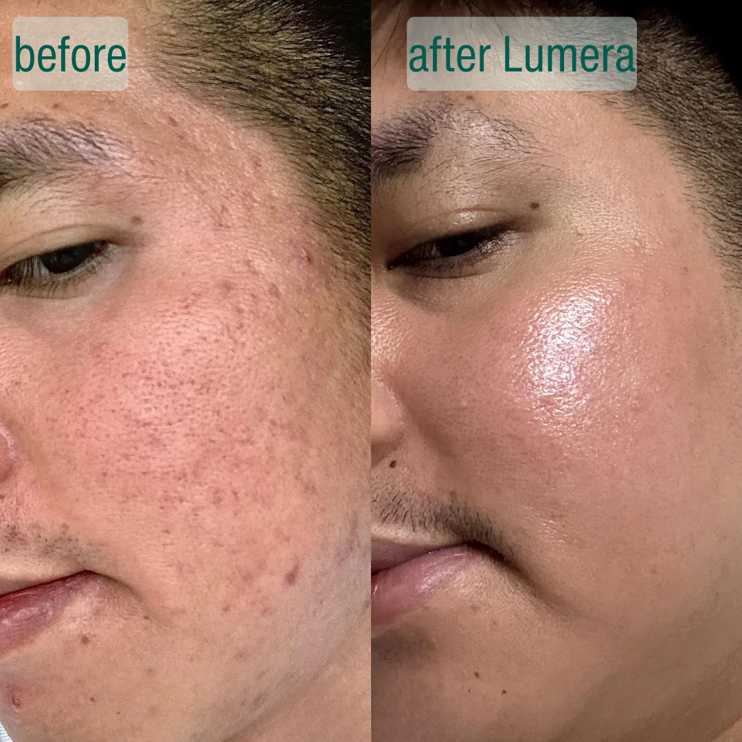 Dermora™ MicroCrystal Nachtserum Duo – Für Sichtbar Glattere Haut & Weniger Sichtbare Aknenarben