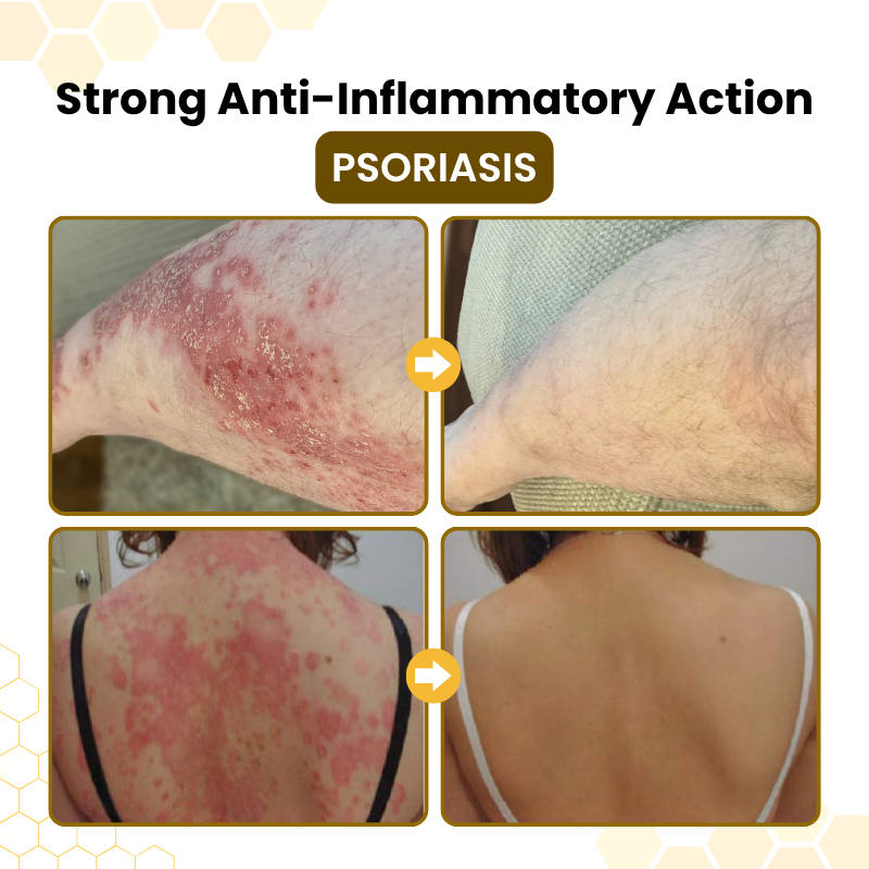CalmiDerm™ Psoriasis-Hautpflegecreme – Juckreiz in 60 Sekunden lindern & schuppige Haut beruhigen