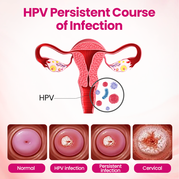 ViraCera™ IntiDefend Anti-HPV Interferon-Gel – Unterstützt HPV-Abwehr, Schleimhautheilung & Intimgesundheit