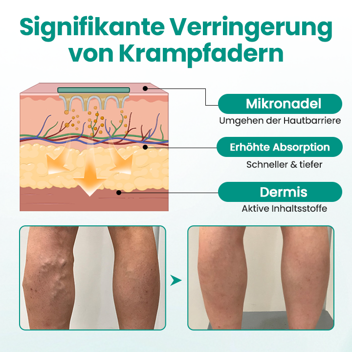 Timilk® LegRenew Krampfaderpflaster