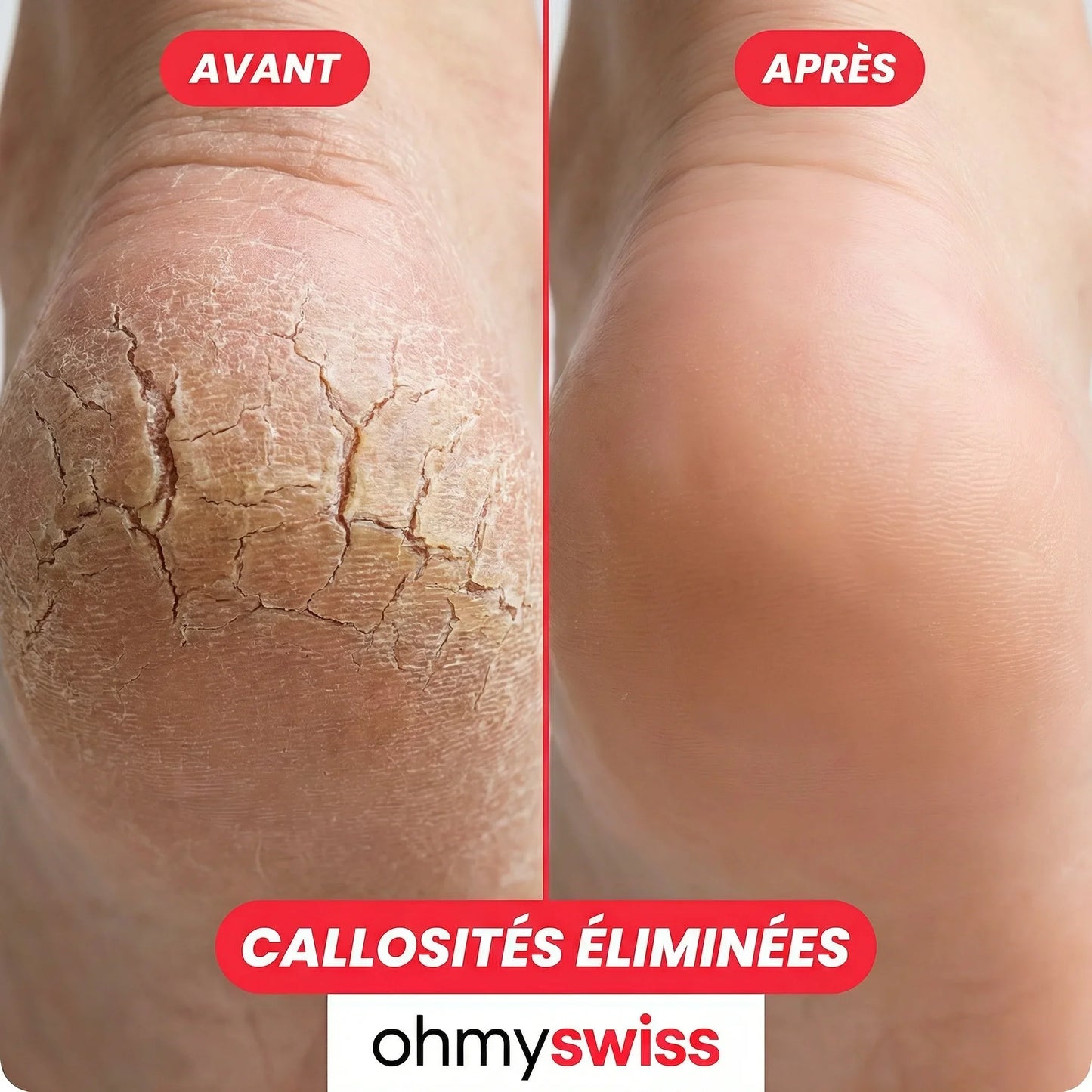 Swiss™ | FootGlow Hornhaut entferner