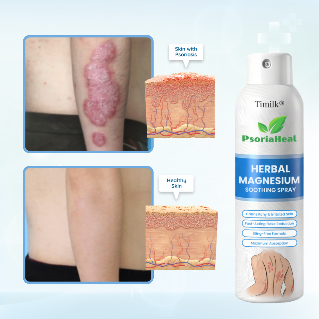 DermaMagna™ PsoriaHeal Magnesium Beruhigungsspray – Schnelle Linderung bei Juckreiz, Rötungen & Hautreizungen