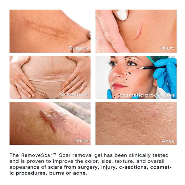 DermaScar™ | Silikon-Narbengel für glattere Haut