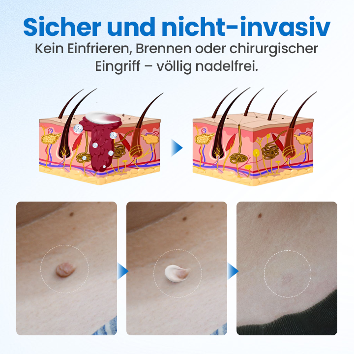 WartClear™ TagGone Warzenentfernungscreme