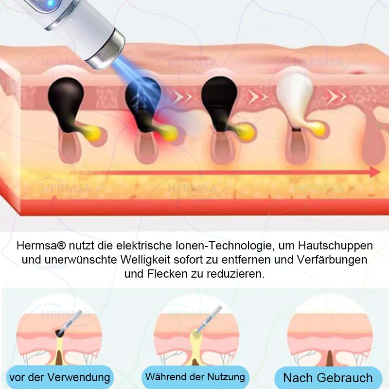 Hermsa® nicht-invasiver Laserpointer - Muttermal- und Warzenentfernung