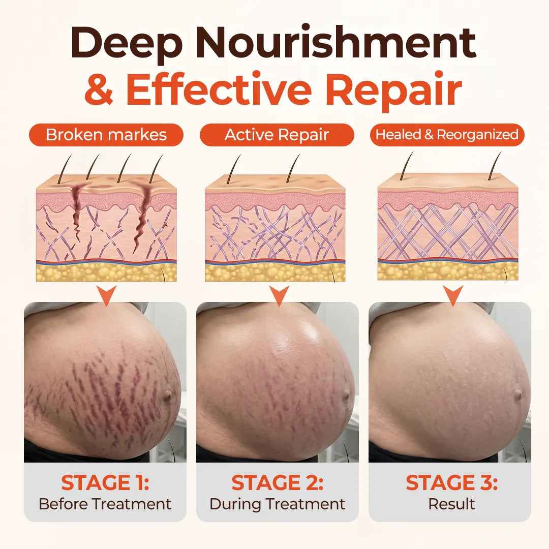 DermaSilk™ Stretch Mark & Scar Oil – Natürlich pflegen, glätten & das Erscheinungsbild von Dehnungsstreifen reduzieren