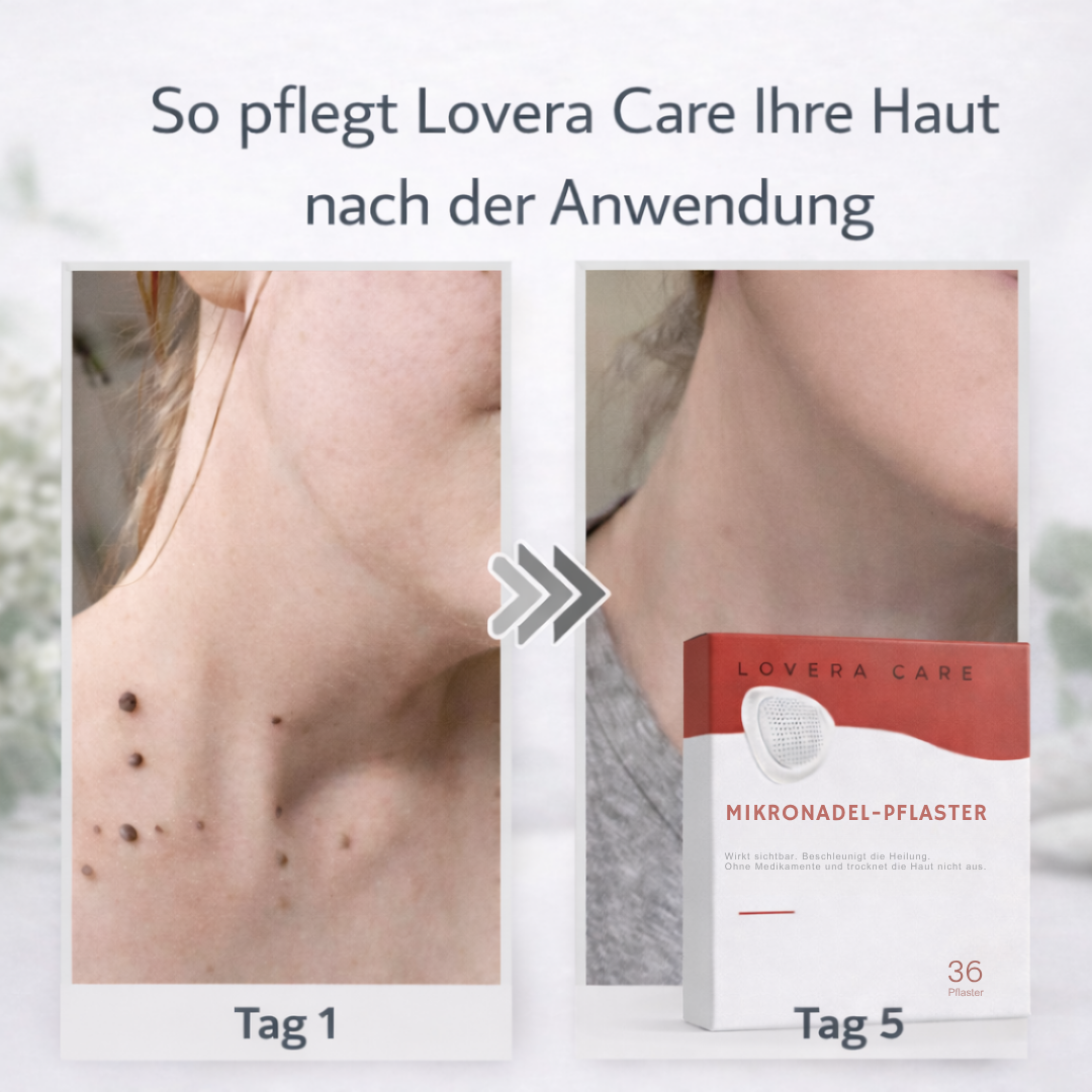 Lovera™ | Pflaster zur Entfernung von Hautanhängseln