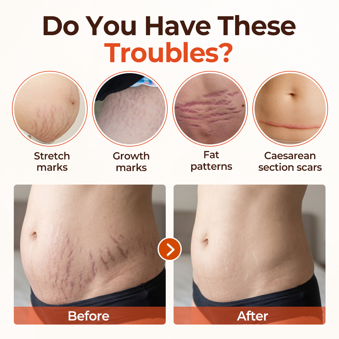 DermaSilk™ Stretch Mark & Scar Oil – Natürlich pflegen, glätten & das Erscheinungsbild von Dehnungsstreifen reduzieren
