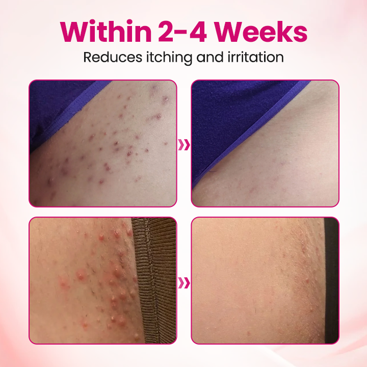 ViraCera™ IntiDefend Anti-HPV Interferon-Gel – Unterstützt HPV-Abwehr, Schleimhautheilung & Intimgesundheit