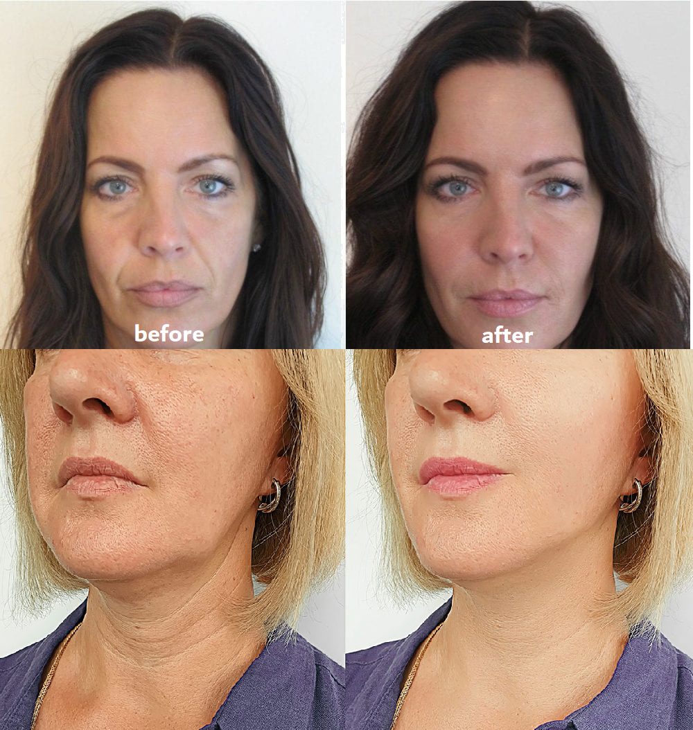 🔥 50% RABATT | GlowLift™ - Anti-Falten-Pads – Für Glatter & Frischer Aussehende Haut