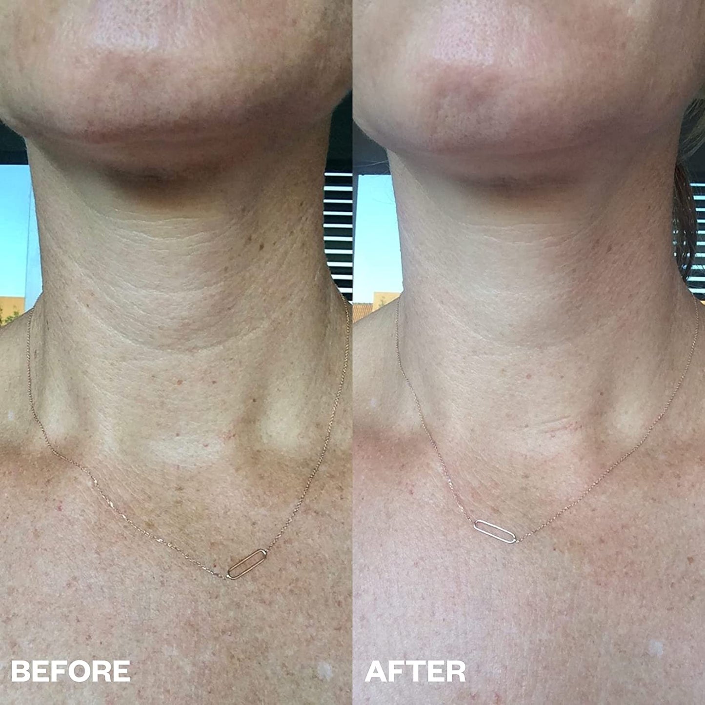 🔥 50% RABATT | GlowLift™ - Anti-Falten-Pads – Für Glatter & Frischer Aussehende Haut