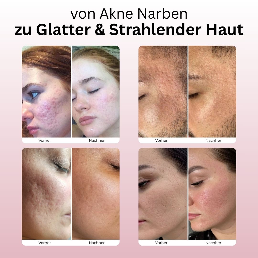 Microneedling-System mit Serum-Infusion