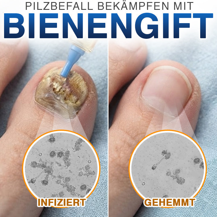 MycoVera™ FungiFree Bienengift-Nagelbehandlung – gegen hartnäckigen Nagelpilz & für gesünderes Nagelwachstum