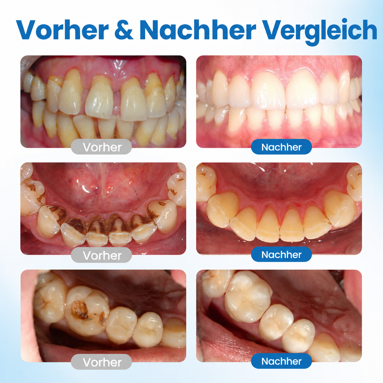 LBMLBM™ | NanoHAP Zahnschutzserum