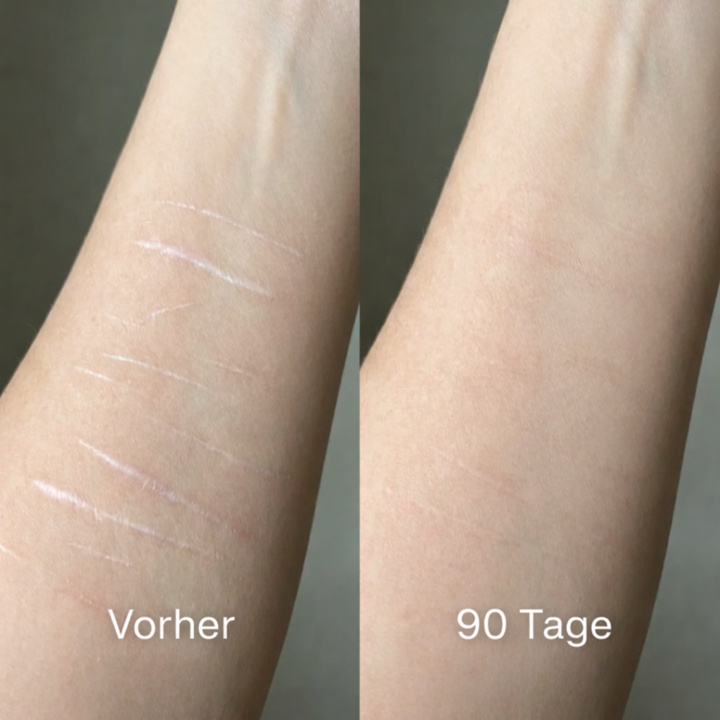 ODALIT™ Silikon-Narbenstick – Zeitlich begrenztes Angebot: | 1+1 gratis🔥Letzter Tag⏰