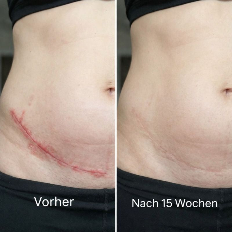 ODALIT™ Silikon-Narbenstick – Zeitlich begrenztes Angebot: | 1+1 gratis🔥Letzter Tag⏰