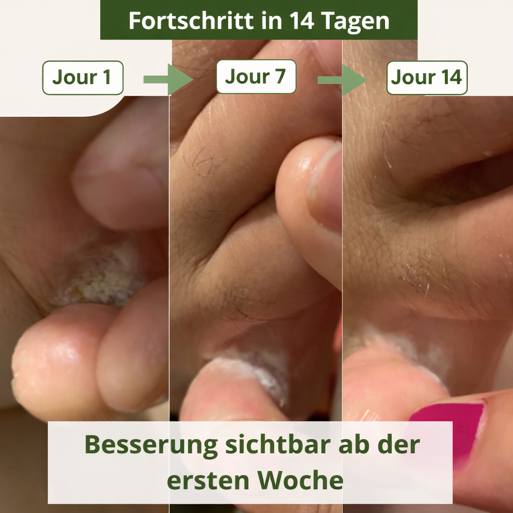 Lyvona® | Anti-Pilz-Seife