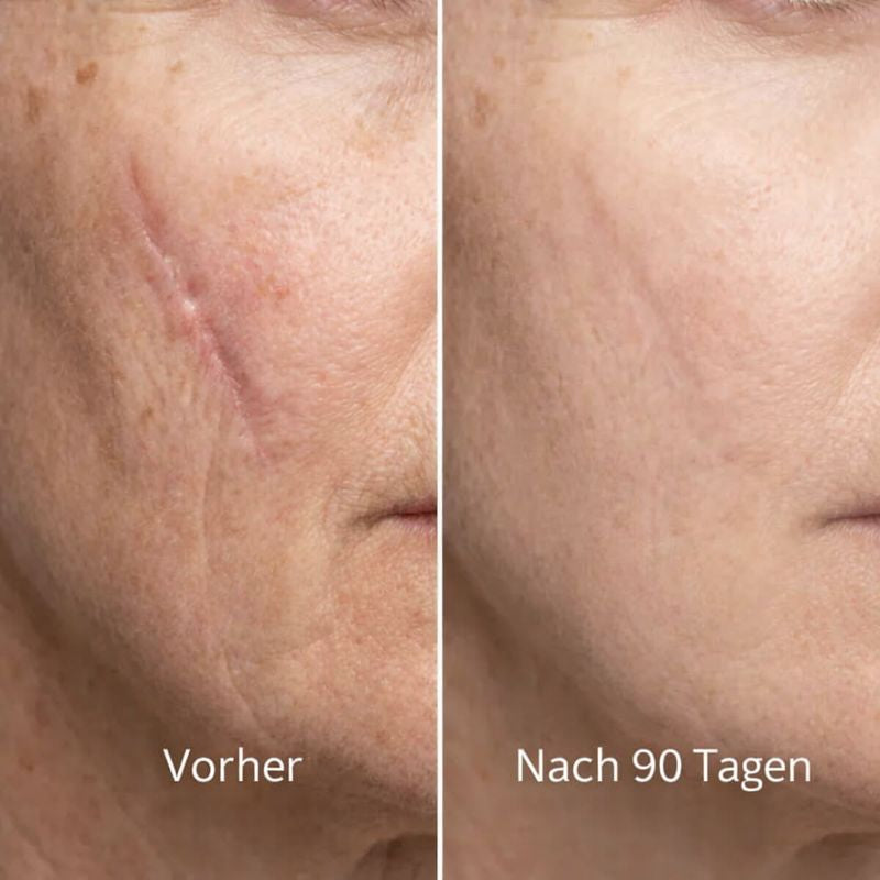 ODALIT™ Silikon-Narbenstick – Zeitlich begrenztes Angebot: | 1+1 gratis🔥Letzter Tag⏰