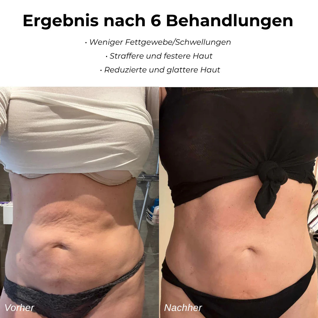VelaSculpt™ Anti-Cellulite-Gerät