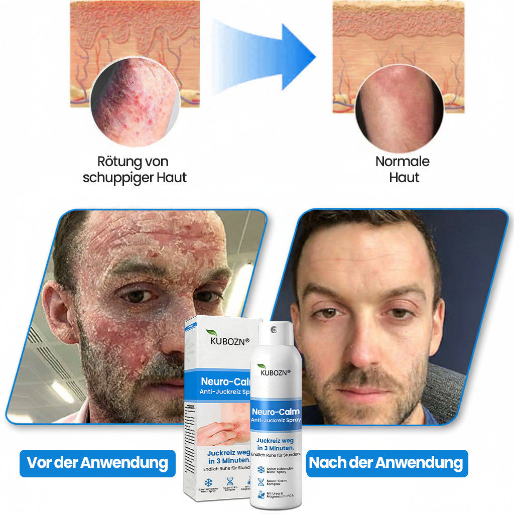 KUBOZN® | Magnesium Kräuter-Spray für Psoriasis-neigende Haut