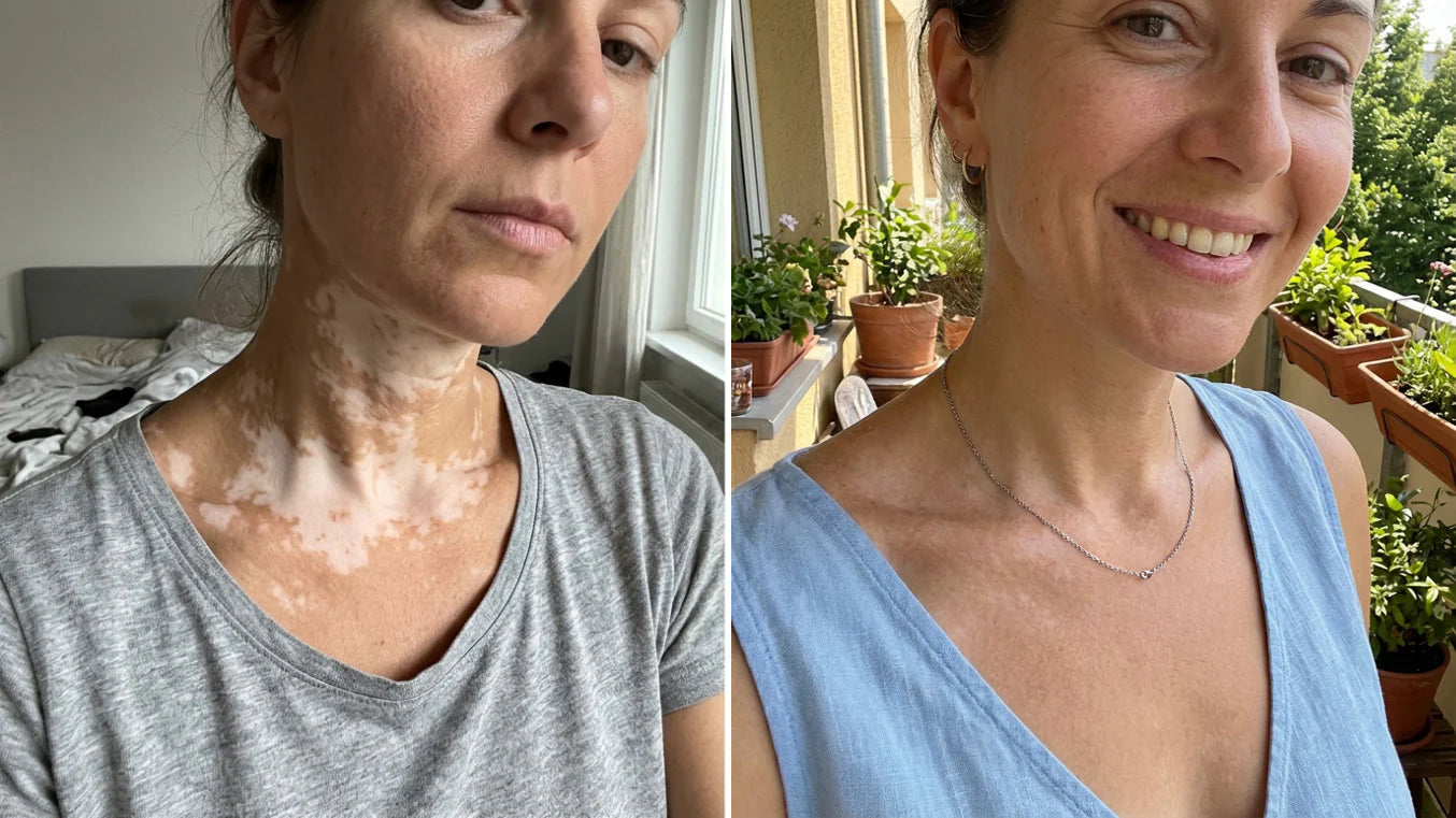 50 % Rabatt | Vitiligo-Repigment-Aktivator-Spray | Neue Verpackung!